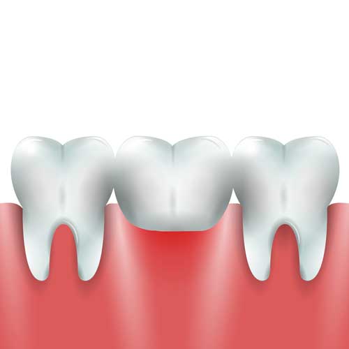 dental bridge brampton