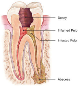 root canal brampton